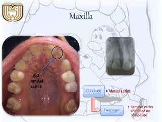 Maxilla
#12
mesial
caries
Condition • Mesial caries
Treatment
• Remove caries
and filled by
composite
 