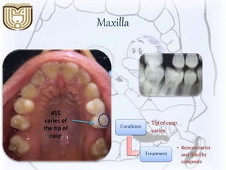 Maxilla
#15
caries of
the tip of
cusp
Condition • Tip of cusp
caries
Treatment
• Remove caries
and filled by
composite
 