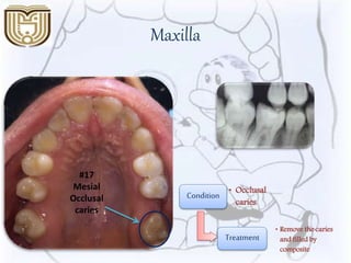 Maxilla
#17
Mesial
Occlusal
caries
Condition • Occlusal
caries
Treatment
• Remove the caries
and filled by
composite
 