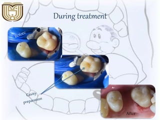 During treatment
After
 