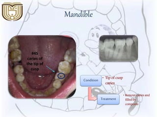 Mandible
Condition • Tip of cusp
caries
Treatment
• Remove caries and
filled by
composite
#45
caries of
the tip of
cusp
 