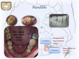 Mandible
Condition
• Occlusal with
buccal fissure
caries
Treatment
• Remove caries and
filled by
composite
#47 occlusal
with buccal
fissure
caries
 