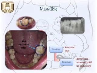 Mandible
Condition • Recurrent
cries
Treatment
• Remove old
resto and build
up and crown
#46
recurrent
cries
 