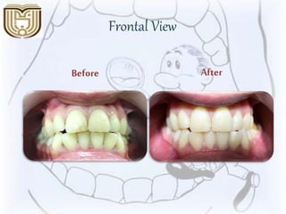 Frontal View
AfterBefore
 