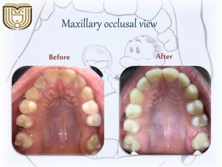Maxillary occlusal view
AfterBefore
 