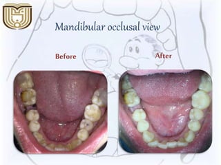 Mandibular occlusal view
AfterBefore
 