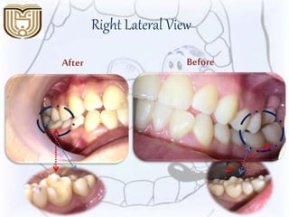 Right Lateral View
BeforeAfter
 