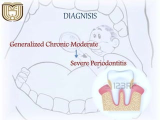 DIAGNISIS
Generalized Chronic Moderate
Severe Periodontitis
 