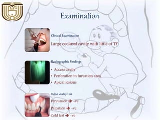 Examination
ClinicalExamination
Large occlusal cavity with little of TF
RadiographicFindings
• Access cavity
• Perforation in furcation area
• Apical lesions
Pulpalvitality Test
Percussion  +ve
Palpation  -ve
Cold test  -ve
 