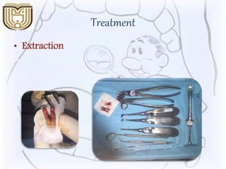 Treatment
• Extraction
 
