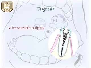 Diagnosis
Irreversible pulpitis
 
