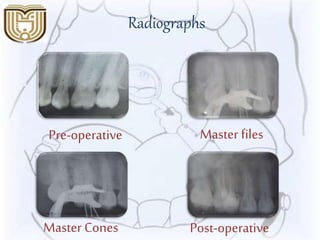 Radiographs
Master Cones Post-operative
Master filesPre-operative
 