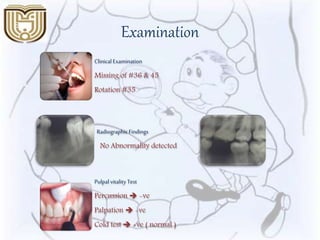 Examination
Clinical Examination
Missing of #36 & 45
Rotation #35
RadiographicFindings
No Abnormality detected
Pulpalvitality Test
Percussion  -ve
Palpation  -ve
Cold test  +ve ( normal )
 