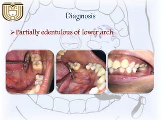 Diagnosis
Partially edentulous of lower arch
 