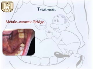 Treatment
Metalo-ceramic Bridge
 