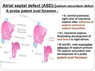 Atrial septal defect (ASD):(ostium secundum defect)
A probe patent oval foramen :
A, normal postnatal,
right veiw of interatrial
septum after adhesion of
septum primum to
septum secondum.
A1, interatrial septum,
illustrating development of
oval fossa in right atrium.
B and B1, note incomplete
adhesion of septum primum
TO septum secundum and
development of a probe

patent oval foramen.

 
