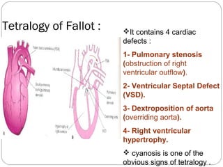 Tetralogy of Fallot :

It contains 4 cardiac
defects :
1- Pulmonary stenosis
(obstruction of right
ventricular outflow).
2- Ventricular Septal Defect
(VSD).
3- Dextroposition of aorta
(overriding aorta).
4- Right ventricular
hypertrophy.
 cyanosis is one of the
obvious signs of tetralogy .

 