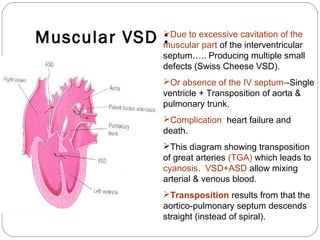 Muscular VSD :

Due to excessive cavitation of the
muscular part of the interventricular
septum….. Producing multiple small
defects (Swiss Cheese VSD).
Or absence of the IV septum--Single
ventricle + Transposition of aorta &
pulmonary trunk.
Complication: heart failure and
death.
This diagram showing transposition
of great arteries (TGA) which leads to
cyanosis. VSD+ASD allow mixing
arterial & venous blood.
Transposition results from that the
aortico-pulmonary septum descends
straight (instead of spiral).

 