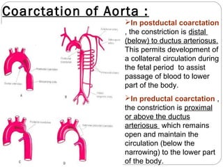 Coarctation of Aorta :
In postductal coarctation
, the constriction is distal
(below) to ductus arteriosus.
This permits development of
a collateral circulation during
the fetal period to assist
passage of blood to lower
part of the body.
In preductal coarctation ,
the constriction is proximal
or above the ductus
arteriosus which remains
open and maintain the
circulation (below the
narrowing) to the lower part
of the body.

 