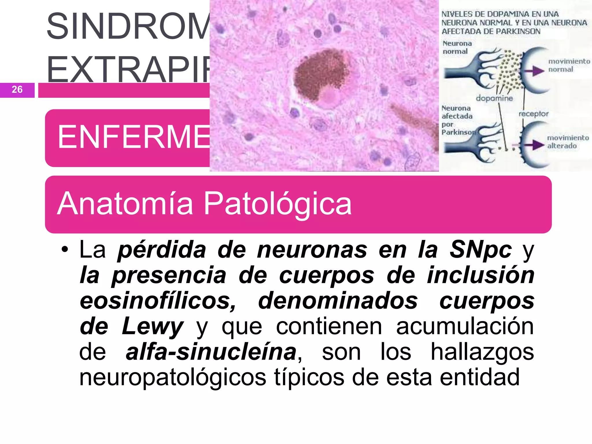 ENFERMEDAD DE PARKINSON
Anatomía Patológica
• La pérdida de neuronas en la SNpc y
la presencia de cuerpos de inclusión
eosinofílicos, denominados cuerpos
de Lewy y que contienen acumulación
de alfa-sinucleína, son los hallazgos
neuropatológicos típicos de esta entidad
SINDROMES
EXTRAPIRAMIDALES26
 