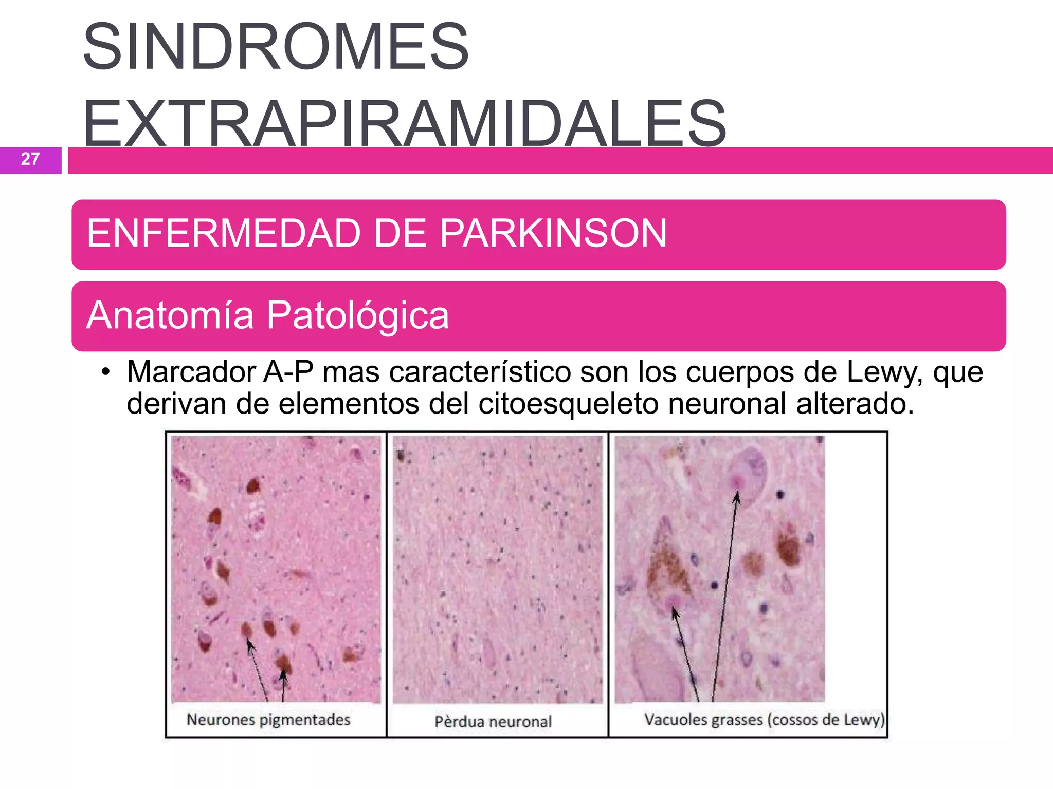ENFERMEDAD DE PARKINSON
Anatomía Patológica
• Marcador A-P mas característico son los cuerpos de Lewy, que
derivan de elementos del citoesqueleto neuronal alterado.
SINDROMES
EXTRAPIRAMIDALES27
 