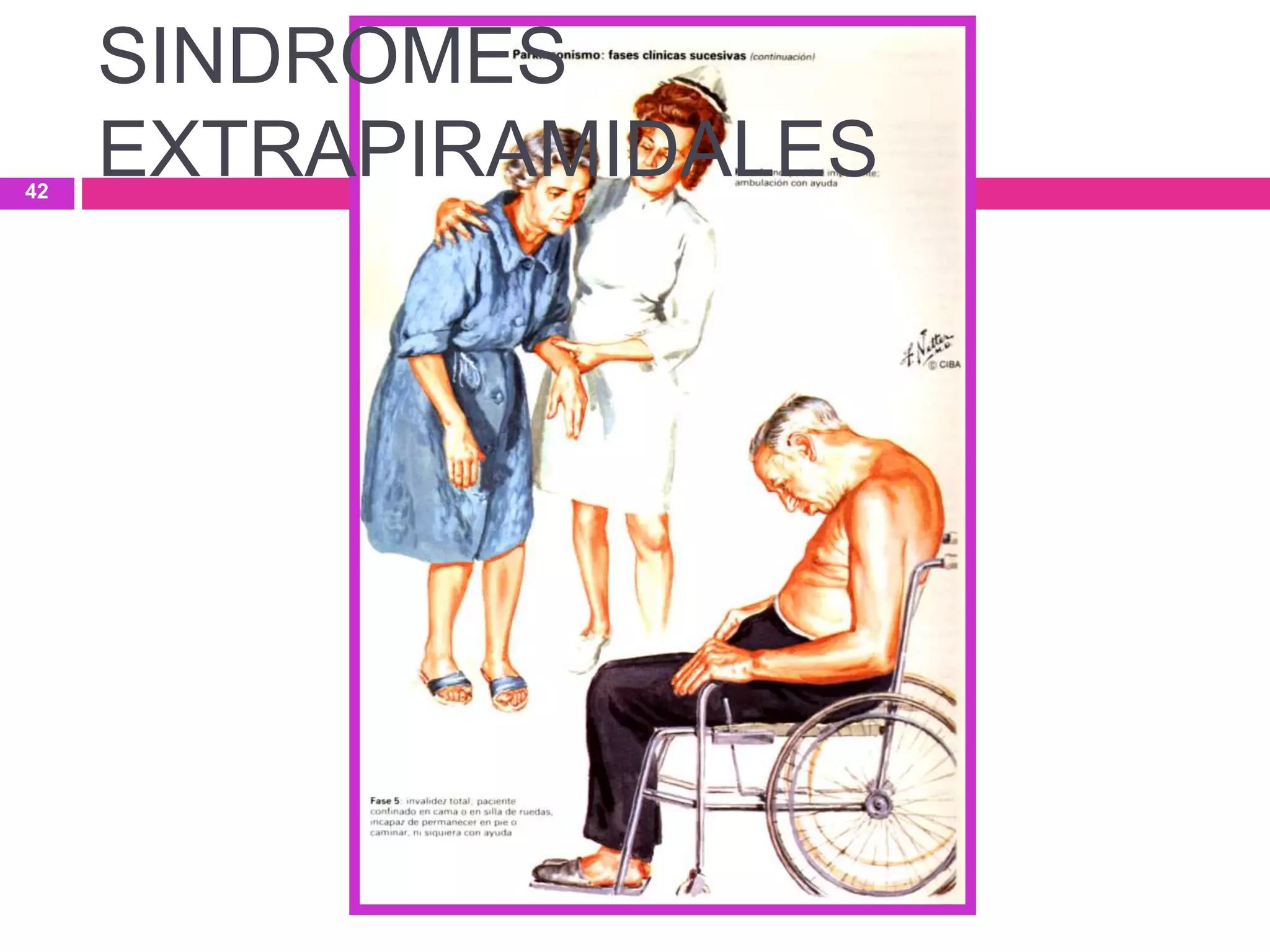42
SINDROMES
EXTRAPIRAMIDALES
 