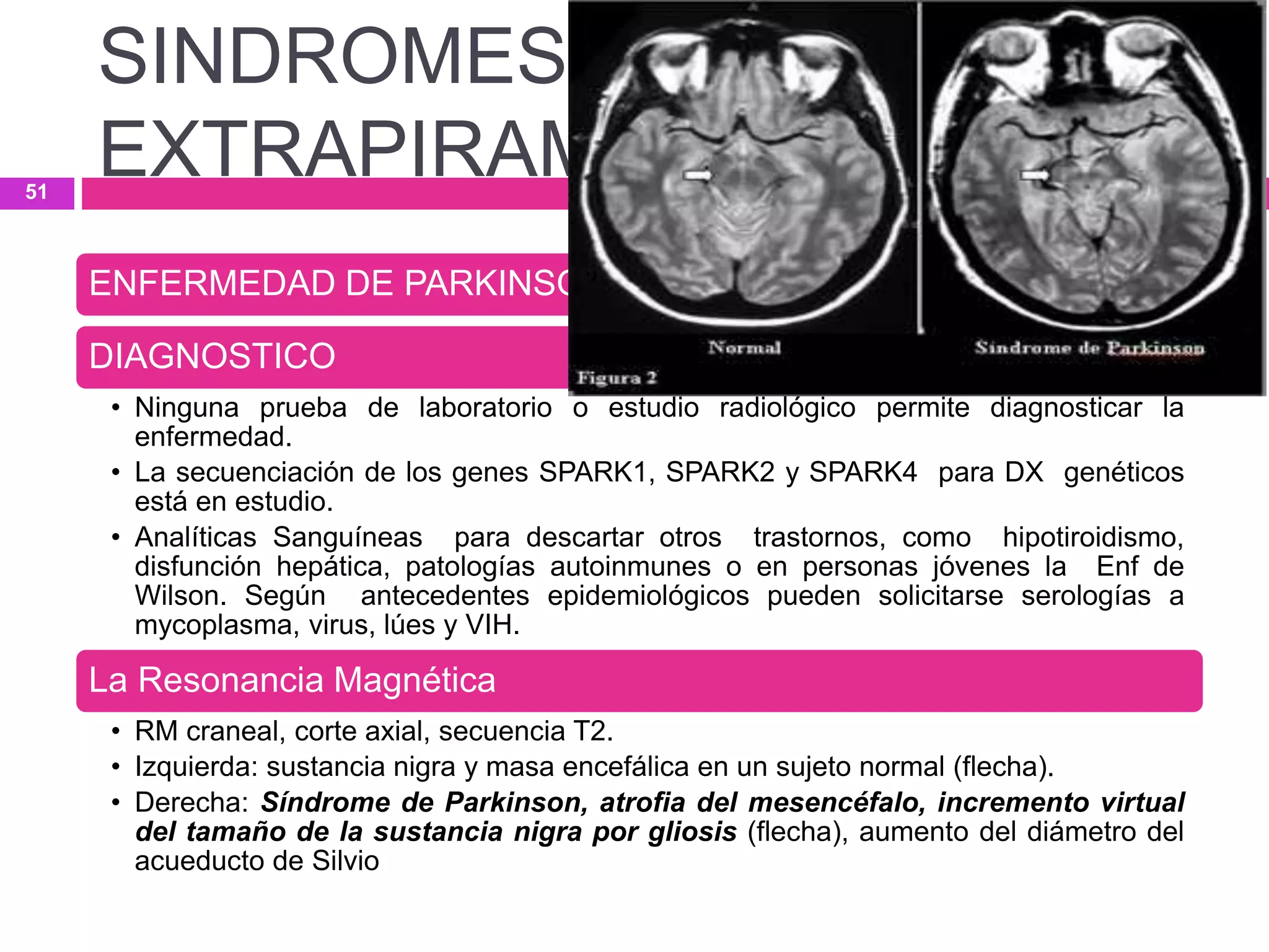 SINDROMES
EXTRAPIRAMIDALES
ENFERMEDAD DE PARKINSON.
DIAGNOSTICO
• Ninguna prueba de laboratorio o estudio radiológico permite diagnosticar la
enfermedad.
• La secuenciación de los genes SPARK1, SPARK2 y SPARK4 para DX genéticos
está en estudio.
• Analíticas Sanguíneas para descartar otros trastornos, como hipotiroidismo,
disfunción hepática, patologías autoinmunes o en personas jóvenes la Enf de
Wilson. Según antecedentes epidemiológicos pueden solicitarse serologías a
mycoplasma, virus, lúes y VIH.
La Resonancia Magnética
• RM craneal, corte axial, secuencia T2.
• Izquierda: sustancia nigra y masa encefálica en un sujeto normal (flecha).
• Derecha: Síndrome de Parkinson, atrofia del mesencéfalo, incremento virtual
del tamaño de la sustancia nigra por gliosis (flecha), aumento del diámetro del
acueducto de Silvio
51
 