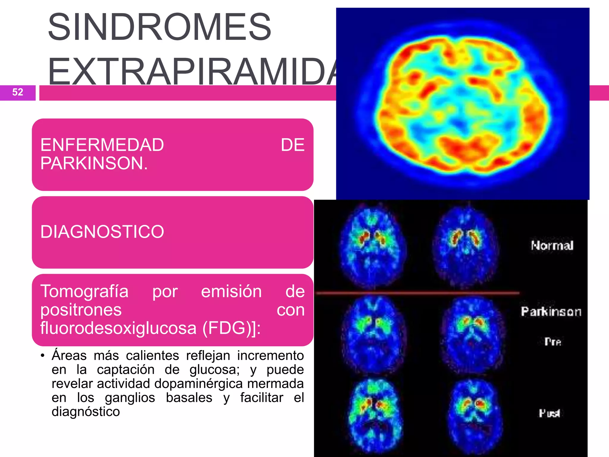 SINDROMES
EXTRAPIRAMIDALES
ENFERMEDAD DE
PARKINSON.
DIAGNOSTICO
Tomografía por emisión de
positrones con
fluorodesoxiglucosa (FDG)]:
• Áreas más calientes reflejan incremento
en la captación de glucosa; y puede
revelar actividad dopaminérgica mermada
en los ganglios basales y facilitar el
diagnóstico
52
 
