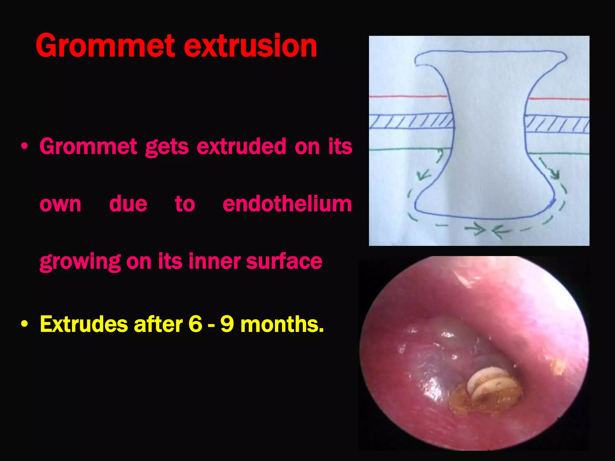 11. non suppurative otitis media | PPT