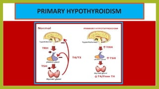PRIMARY HYPOTHYROIDISM
 