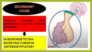 HEALTHY THYROID THAT
GENERATES A LOT OF THYROID
HORMONE
IN RESPONSETOTSH-
SECRETINGTUMOR IN
ANTERIOR PITUITARY
 