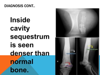 Chronic osteomyelitis | PPT