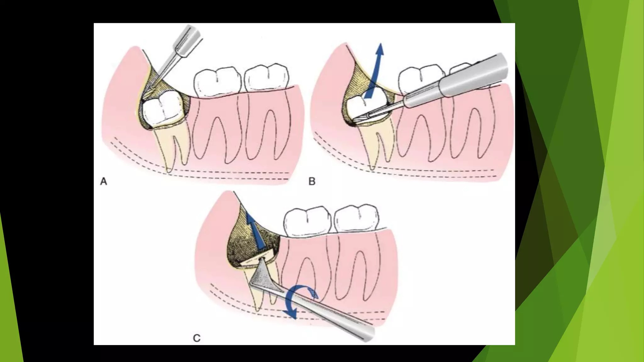 Simple Tooth Impaction Impacted Teeth | PPTX