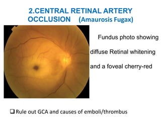 2.CENTRAL RETINAL ARTERY
OCCLUSION (Amaurosis Fugax)
Fundus photo showing
diffuse Retinal whitening
and a foveal cherry-red
spot
Rule out GCA and causes of emboli/thrombus
 