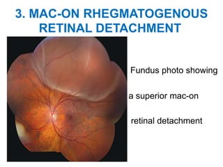 3. MAC-ON RHEGMATOGENOUS
RETINAL DETACHMENT
Fundus photo showing
a superior mac-on
retinal detachment
 