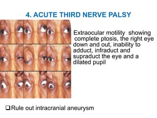 4. ACUTE THIRD NERVE PALSY
Extraocular motility showing
complete ptosis, the right eye
down and out, inability to
adduct, infraduct and
supraduct the eye and a
dilated pupil
Rule out intracranial aneurysm
 