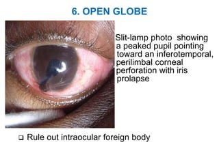 6. OPEN GLOBE
Slit-lamp photo showing
a peaked pupil pointing
toward an inferotemporal,
perilimbal corneal
perforation with iris
prolapse
 Rule out intraocular foreign body
 