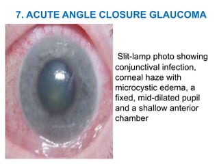 7. ACUTE ANGLE CLOSURE GLAUCOMA
Slit-lamp photo showing
conjunctival infection,
corneal haze with
microcystic edema, a
fixed, mid-dilated pupil
and a shallow anterior
chamber
 