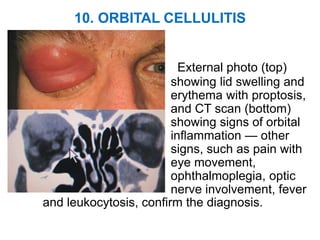 10. ORBITAL CELLULITIS
External photo (top)
showing lid swelling and
erythema with proptosis,
and CT scan (bottom)
showing signs of orbital
inflammation — other
signs, such as pain with
eye movement,
ophthalmoplegia, optic
nerve involvement, fever
and leukocytosis, confirm the diagnosis.
 