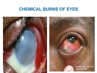 CHEMICAL BURNS OF EYES
 