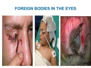FOREIGN BODIES IN THE EYES
 