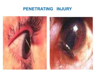PENETRATING INJURY
 