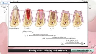 Healing process following tooth extraction Reference: Avila-Ortiz and Zadeh; 2019
 