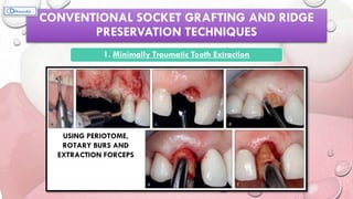 CONVENTIONAL SOCKET GRAFTING AND RIDGE
PRESERVATION TECHNIQUES
1. Minimally Traumatic Tooth Extraction
USING PERIOTOME,
ROTARY BURS AND
EXTRACTION FORCEPS
 