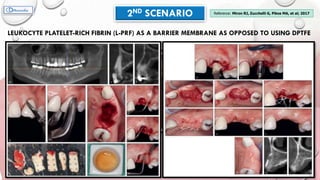 LEUKOCYTE PLATELET-RICH FIBRIN (L-PRF) AS A BARRIER MEMBRANE AS OPPOSED TO USING DPTFE
2ND SCENARIO Reference: Miron RJ, Zucchelli G, Pikos MA, et al; 2017
 