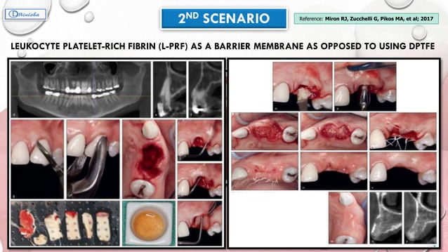 Ridge augmentation | PPTX