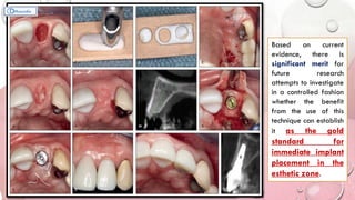 Based on current
evidence, there is
significant merit for
future research
attempts to investigate
in a controlled fashion
whether the benefit
from the use of this
technique can establish
it as the gold
standard for
immediate implant
placement in the
esthetic zone.
 