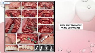 RIDGE SPLIT TECHNIQUE
USING OSTEOTOMES
 