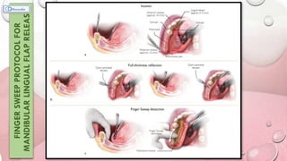 FINGER
SWEEP
PROTOCOL
FOR
MANDIBULAR
LINGUAL
FLAP
RELEASE
 