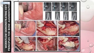 WORKFLOW
DEMONSTRATING
KEY
PRINCIPLES
FOR
BONE
AUGMENTATION
 